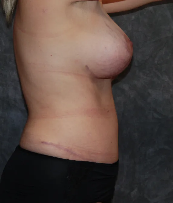 Tummy Tuck