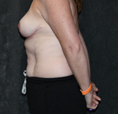 Breast Reduction