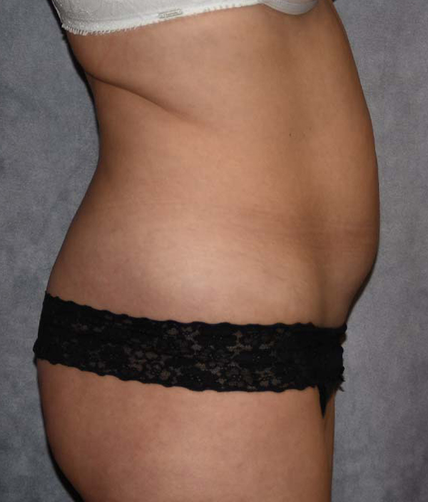 Tummy Tuck