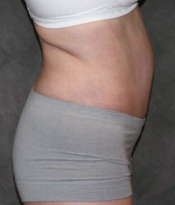 Tummy Tuck