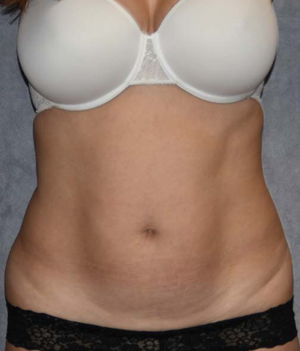 Tummy Tuck