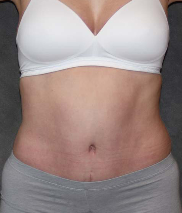 Tummy Tuck