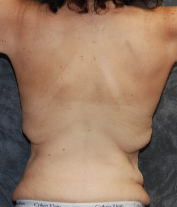 Tummy Tuck
