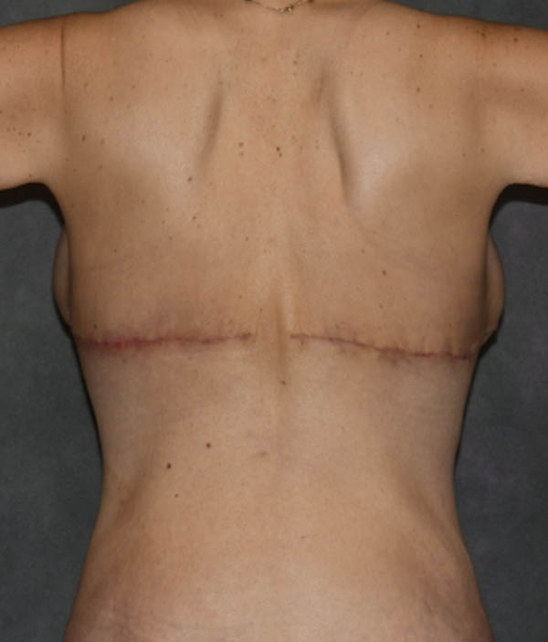 Tummy Tuck