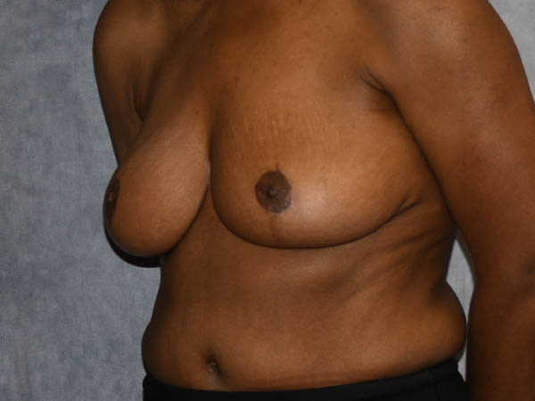 Breast Reduction