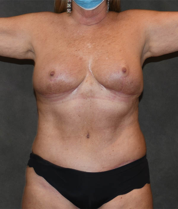 Tummy Tuck