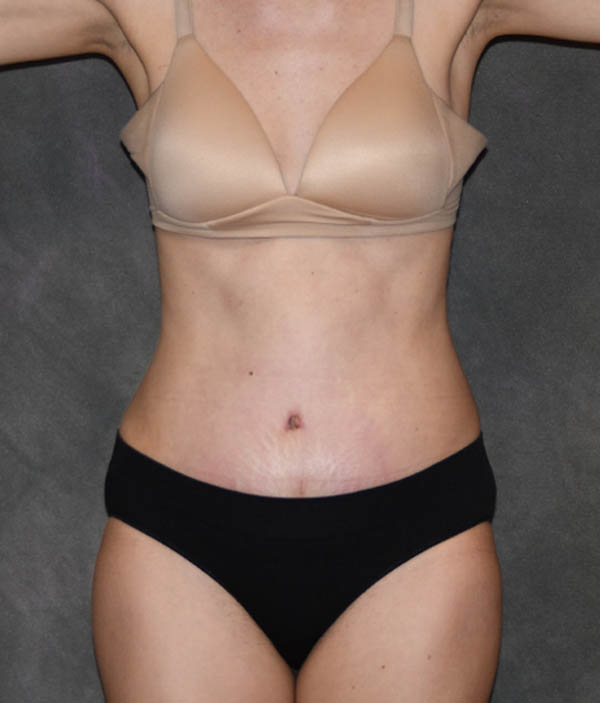Tummy Tuck