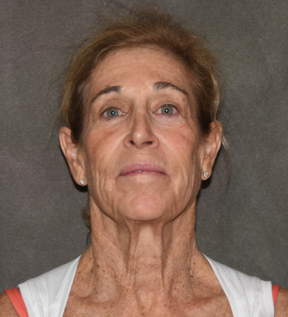 Facelift