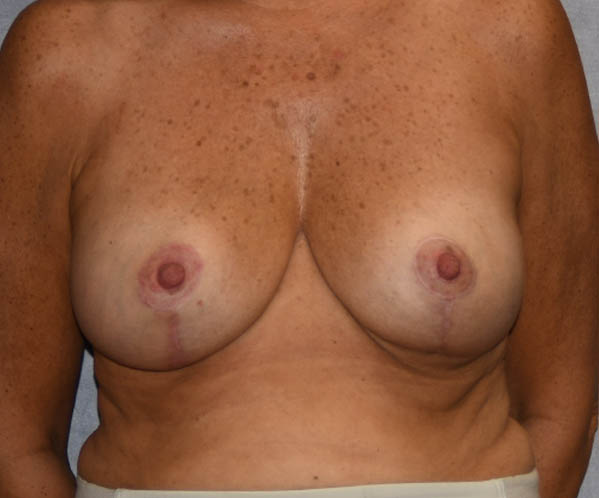 Breast Lift