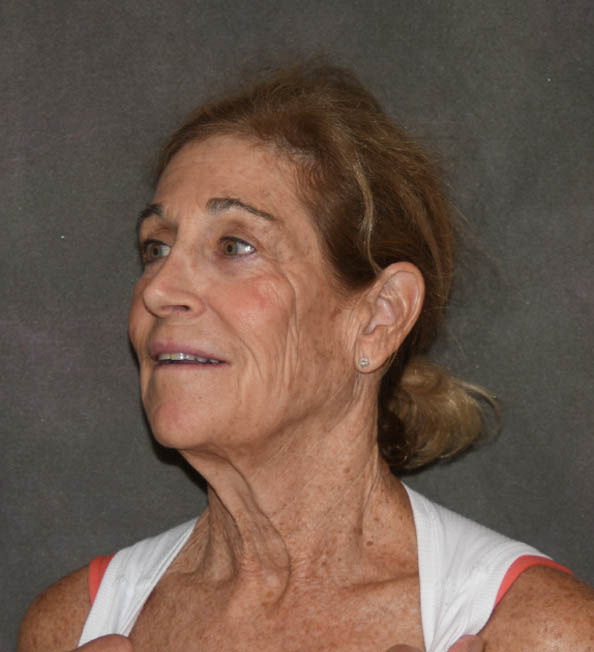 Facelift