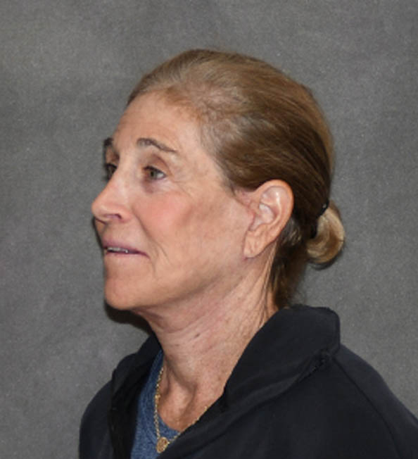 Facelift