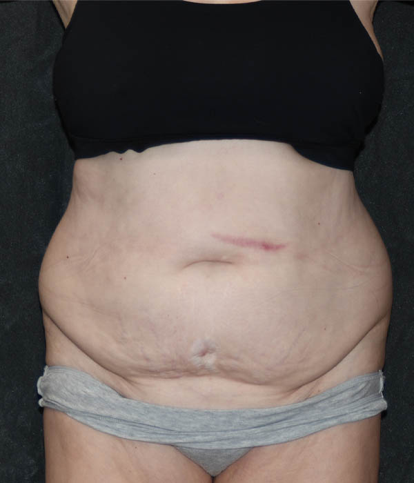 Tummy Tuck