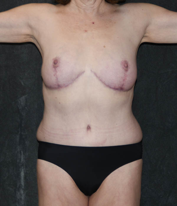 Tummy Tuck