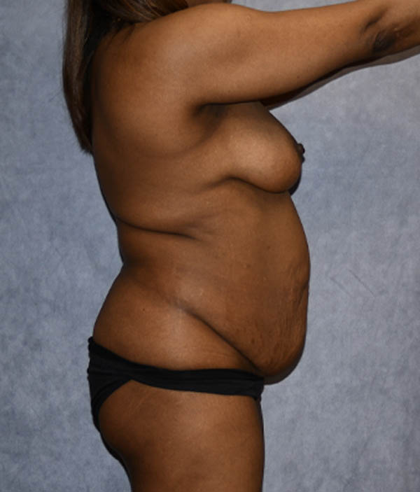 Tummy Tuck