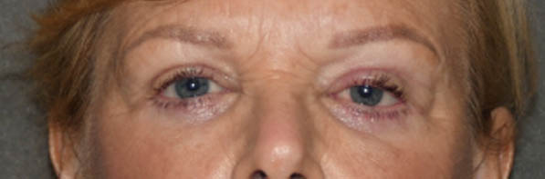 Eyelid Surgery