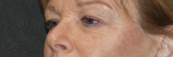 Eyelid Surgery