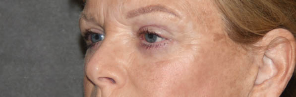 Eyelid Surgery