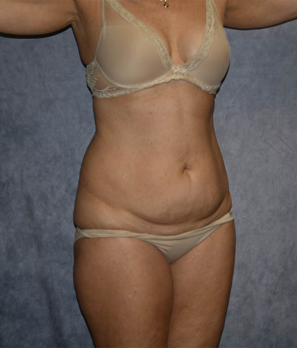 Tummy Tuck