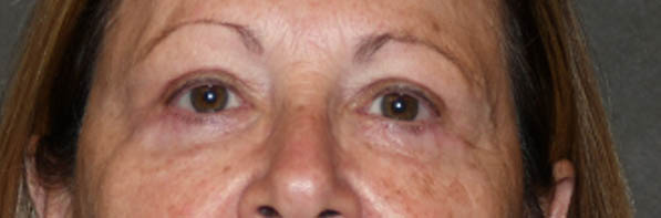Eyelid Surgery