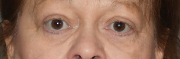 Eyelid Surgery