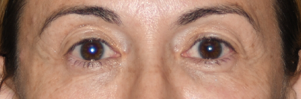 Eyelid Surgery