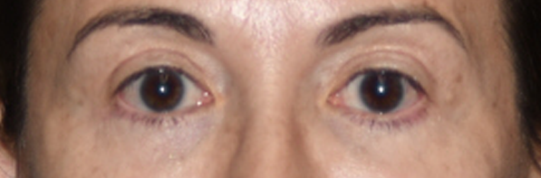 Eyelid Surgery