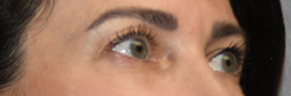 Eyelid Surgery