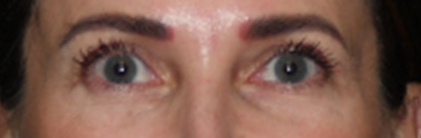 Eyelid Surgery