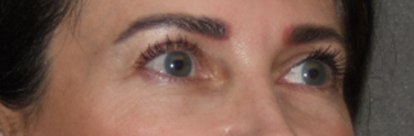 Eyelid Surgery