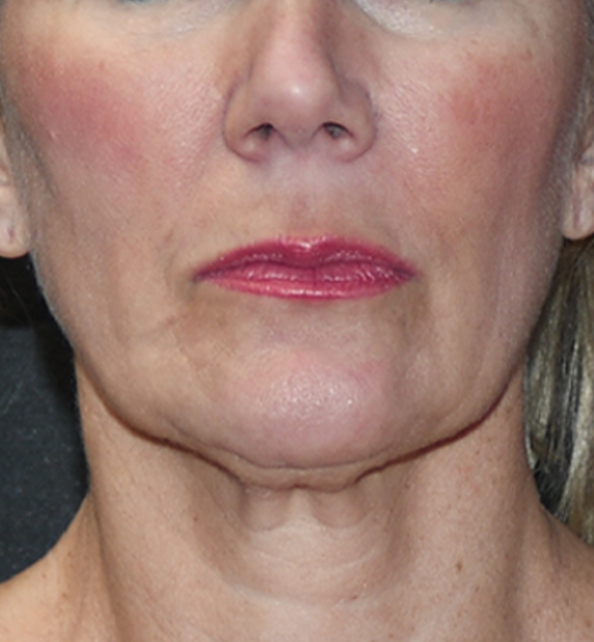 Facelift