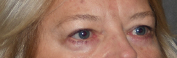 Eyelid Surgery