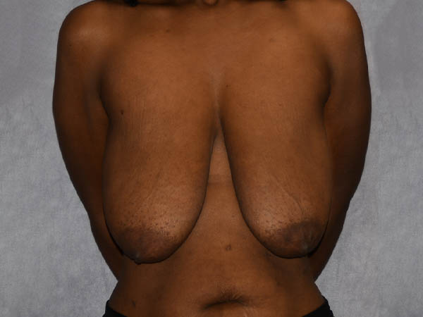 Breast Reduction