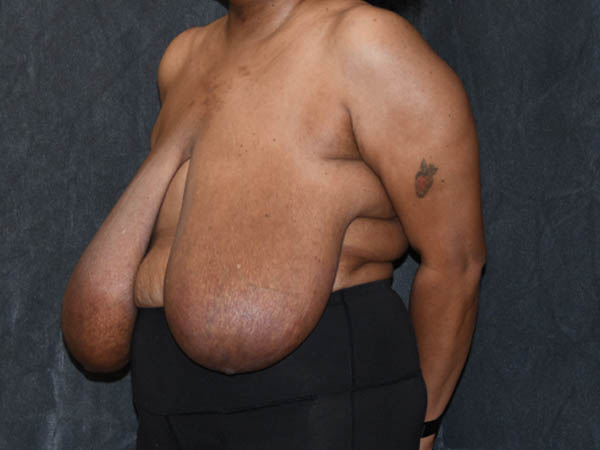 Breast Reduction