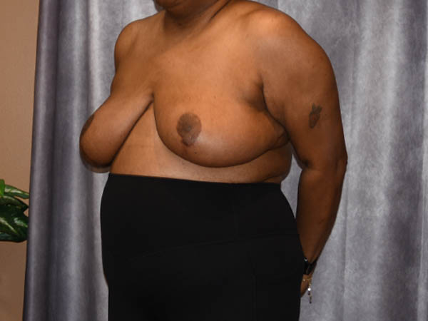 Breast Reduction