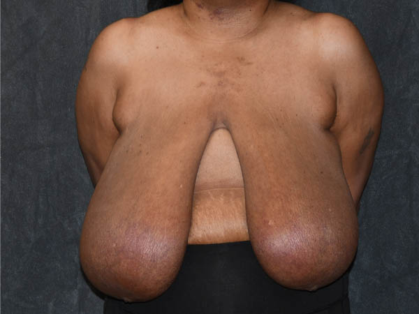 Breast Reduction