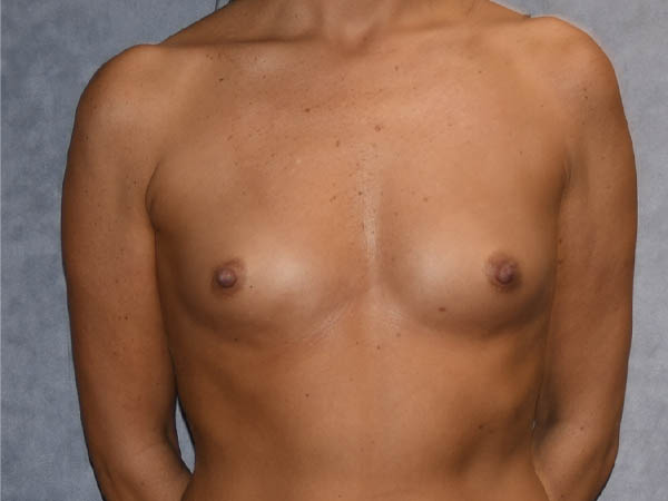 Breast Augmentation