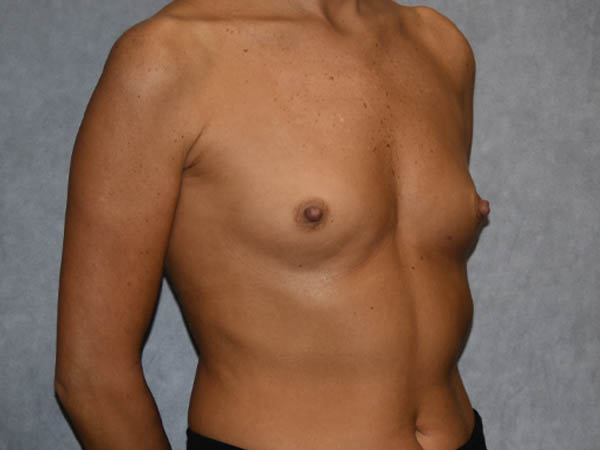 Breast Augmentation