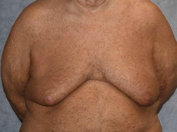 Gynecomastia