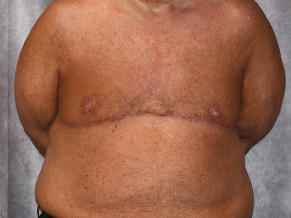 Gynecomastia