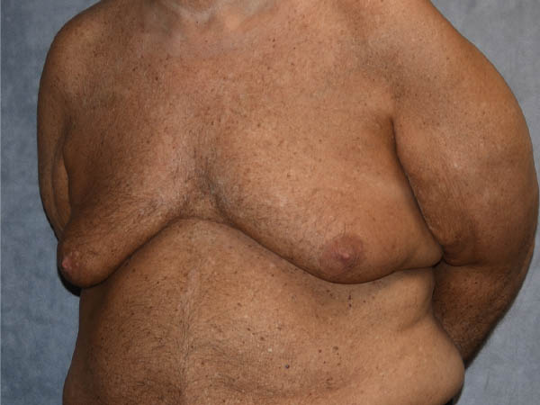 Gynecomastia