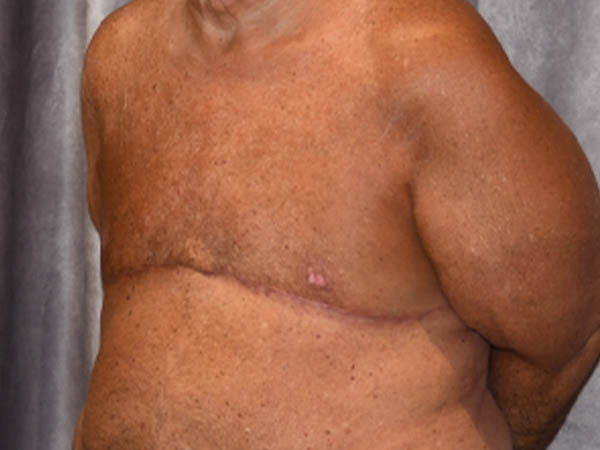 Gynecomastia