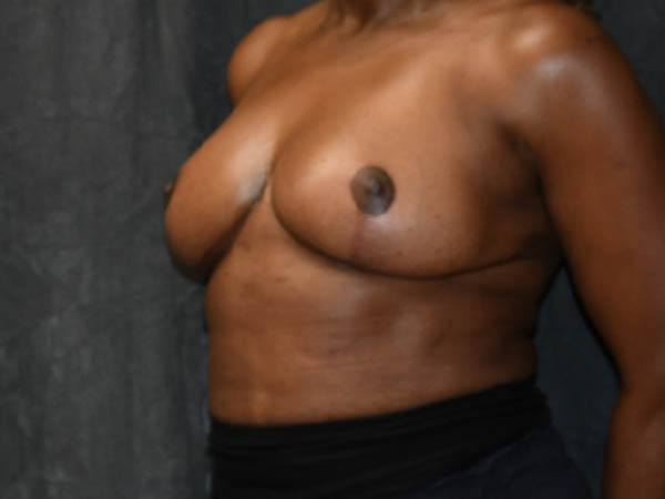 Breast Reduction