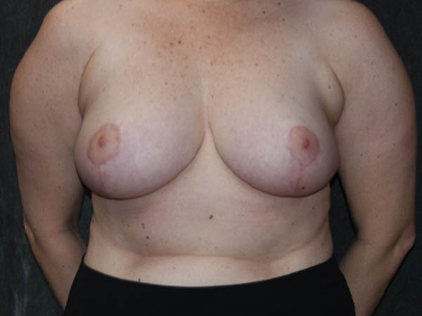 Breast Reduction