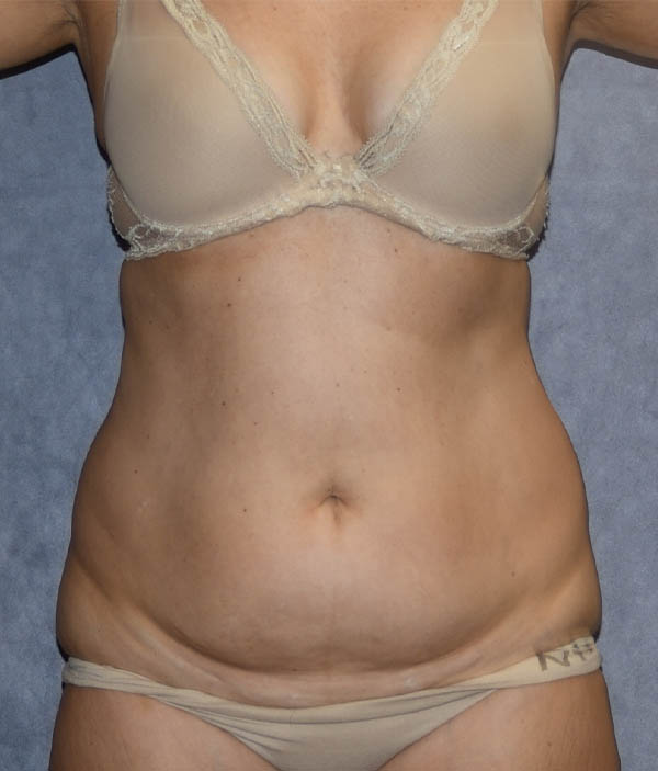 Tummy Tuck