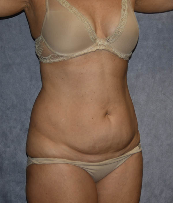 Tummy Tuck