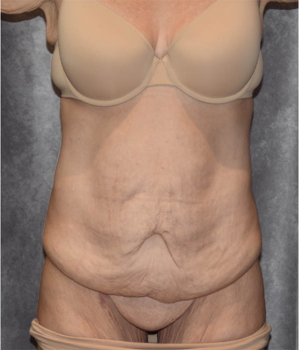 Tummy Tuck