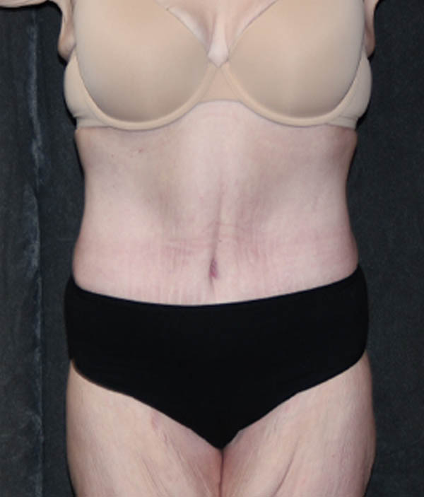 Tummy Tuck