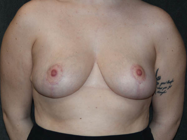 Breast Reduction