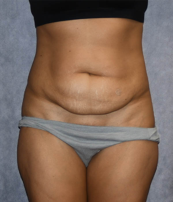 Tummy Tuck