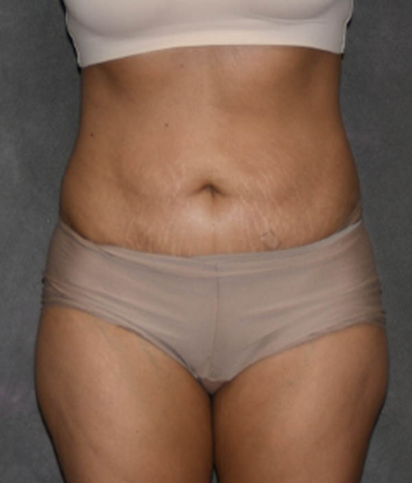 Tummy Tuck
